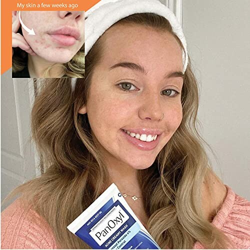 Woman smiling and holding a tube of PanOxyl with a before image of acne.